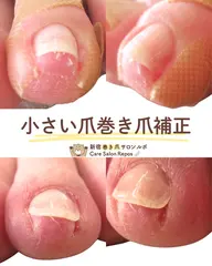 5月末まで！モニター様価格【小さい爪の巻き爪補正（指1本）　2,200円】