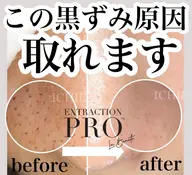 【毛穴美人】毛穴エクストラクションプロ(ヘッドスパorデコルテ付)