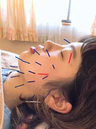 全身施術+美容鍼