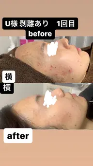 剥離あり【ニキビ、ニキビ跡にお悩みの方に】フェイシャルハーブピーリング ♪ メンズの方は絶対に剥離あり◎15000円