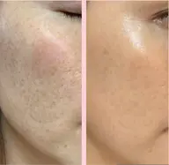 お肌を生まれ変わらせる✨【バクテリウムピール】