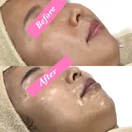 ビタミンC入りのピーリング➕リンパマッサージ付き！レカルカ×DRBBエステの体験版！クスミ抜けと艶肌に♡