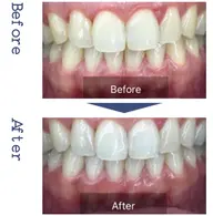 セルフホワイトニング🦷