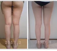 二の腕、お腹、太もも、ふくらはぎ、背中から1箇所選択し、セルライトケアをいたします。