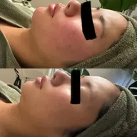 【メイクのり抜群💄】お試し♪お顔の剥離なしハーブピーリング🌿ニキビ◦ニキビ跡◦肌荒れ◦シミ