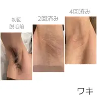 【脱毛】《襟足、ワキ、ヒジ上、ヒジ下》各¥1,500🌟