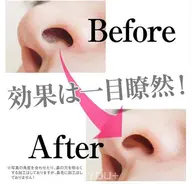 【鼻毛ワックス脱毛】