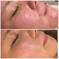 【🥵赤ら顔・毛穴の気になる方🥵】ピーリング+イオンパック+W鎮静