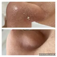 毛穴詰まり・ザラつき改善ショートコース⚡️