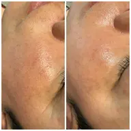 【大人の肌改善×巻き戻し美容】TGFでハリ・弾力UP8,800円→7,700円