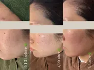 【60%off】エステペン+ハーブピーリング