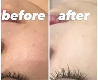 3周年限定【顔脱毛】or【VIO光脱毛】どちらか選べるお試しプラン