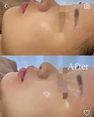 💎お悩みにあった美容液を選択💎【ララピール×アクアダーマ】ピーリング×美容液導入❕これからのお肌作りにおすすめ🪞✨