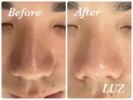 ⭐️初回限定⭐️メンズの肌悩み😒メンズ毛穴ケア・黒ずみ撃退エステ蕨・南浦和駅送迎/男性施術者/完全個室/駐車場完備/