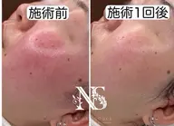 【初夏限定】毛穴洗浄x冷却鎮静x小顔リフト80分再来12660 →新規 10560(税込)
