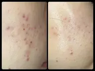 特別モニター募集❣️【ニキビ】【毛穴の黒ずみ】でお悩みの方✨エステ8回(1回3000円)＋エンビロン製品10%OFF