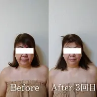 小顔矯正65分✕5回コース