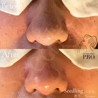 【フェイシャル】メンズも🆗毛穴のお悩み解決✖️スッキリ小顔に💫スペシャルフェイシャル🧖🏻‍♀️