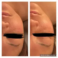 痩身エステ【顔、首、デコルテ】