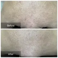 《男女OK》初回ボディハーブピーリング【背中上or二の腕orお尻】¥9800