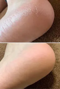 フットケア角質ケア　驚く程ツルツルに✨❗️