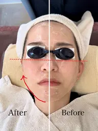 【光フェイシャル】お肌のハリ/リフトアップ/毛穴引き締め/シミ/ニキビ/くすみ/赤み/肌の色むら