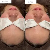 WAX脱毛＊フェイシャル