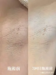 レディースワキ脱毛