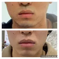 ミニモ学割★今なら2回×20分1000円【メンズ様☆大人気❣️】髭・vioに特化！毎日のめんどうな髭剃りからも卒業です