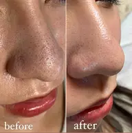 角質もスッキリ✨ツヤすべ肌に♡フェイシャルワックス脱毛👳‍♀️✨〘他メニューとセットで2000円引き〙