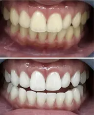 【人気度No.1】ハイパワーコース～初回限定超集中コース～ 15分×3照射