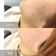 【毛穴の黒ずみ・角栓ケア】お肌がキレイになるフェイスワックス1パーツ⭐︎ お顔の気になる産毛を、丁寧にケア♪