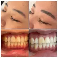 【✨サブスク会員様限定✨】〈1種類通い放題プラン〉眉毛ワックス脱毛、セルフホワイトニング、光フェイシャル、韓国式毛穴洗浄