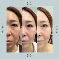 ExoLift エクソリフト【自己再生能力を最大限に引き出す肌改善プログラム】