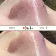 おかえりクーポン【再来】前回のご予約から3週間以内のご予約の場合、割引あり！吸引+お悩みに合わせた美容液