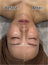 【小顔も透明感も】炭酸ガスケア込リフトアップフェイシャル+美容成分導入