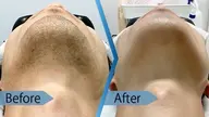 【メンズ】ヒゲ脱毛♪¥3000　《痛みの少ないデザイン脱毛◎日焼け肌OK》