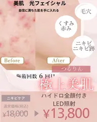 🎊新メニュー🎊🌟美肌光フェイシャル🌟【ニキビケア】【毛穴ケア】ハイドロスプラッシュ×LED照射付き★