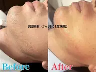 【メンズ】ヒゲ脱毛