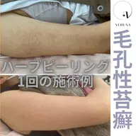 二の腕のブツブツに！剥離ありハーブピーリング🌿