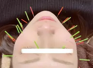 ミニモ限定価格⭐️美容鍼(美顔鍼)30分