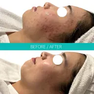 【徹底ニキビケア✨】結果を出したい方へ！フォトRF肌質改善・ニキビ・跡解消　¥3,980