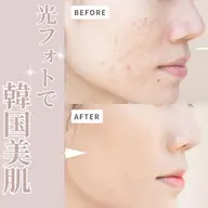 🌸4月限定|花粉荒れケアキャンペーン💓🌈光フェイシャル × 💨水光エアバリ × ⚡EMS💎