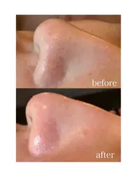 【*10名様限定*平日モニター募集】アクアピール+毛穴洗浄×高保湿ポレーション導入　全顔　2回　¥9800