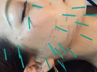 小顔になれる美容鍼30本 ヘッドマッサージ付き🎶お顔のむくみ解消、ターンオーバーを整える!