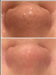 【ミニモ限定】お肌の黒ずみ・毛穴詰まり改善　ハイドラワン毛穴洗浄