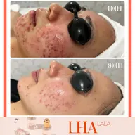 💠5月来店限定💠《第4世代ララピール+美肌LEDライト》#ニキビケア#毛穴ケア#ツヤ肌#シワたるみケア