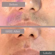 夕方の青ヒゲが気になる方に人気のメニュー🌟【メンズ全顔脱毛】青ヒゲ改善🥸✨