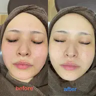 【初回体験】ツルもちお肌✨ハイドラフェイシャル&エレクトロポレーション