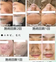 次世代ハーブトリートメント🌿肌質改善、シミ、シワ、ニキビ肌、ニキビ後、毛穴、黒ずみ、美白